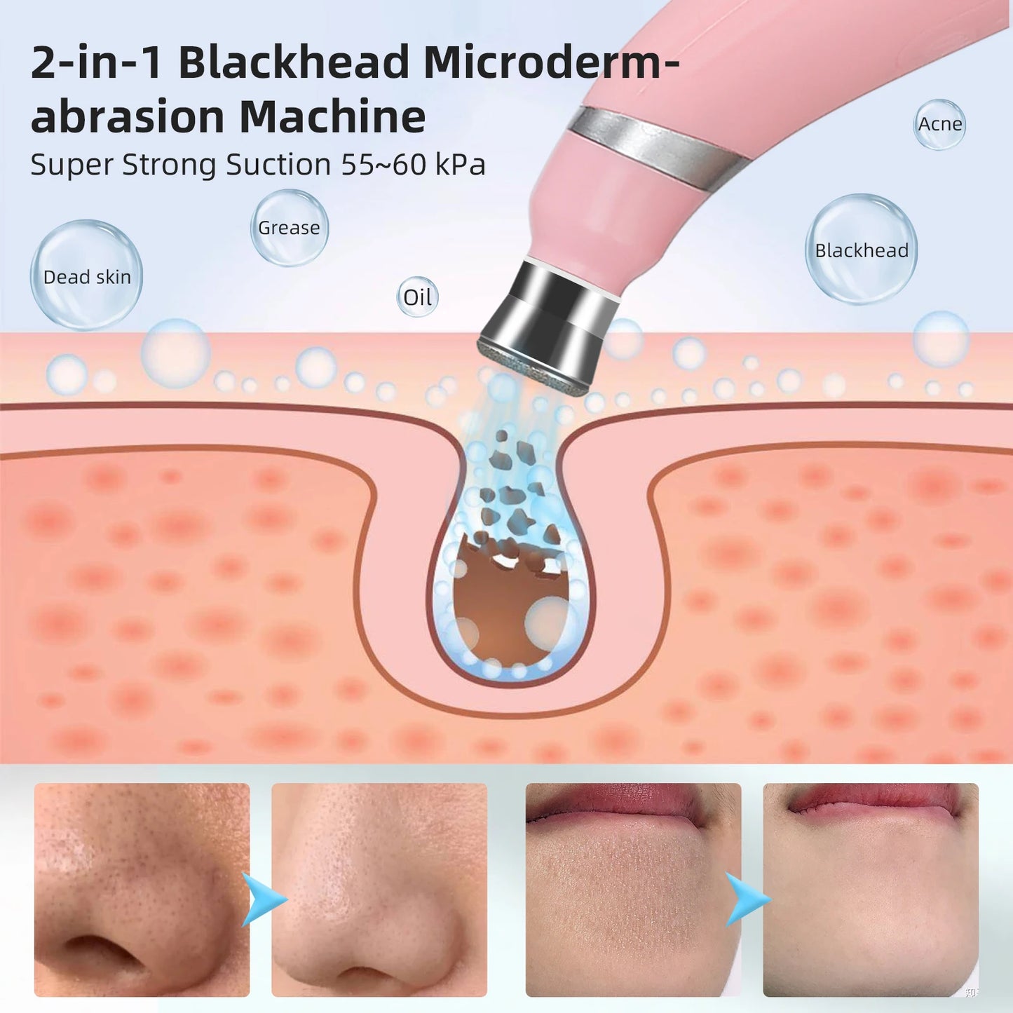 Appareil micro dermabrasion maison 2-en-1 pour éliminer les points noirs et les peaux mortes