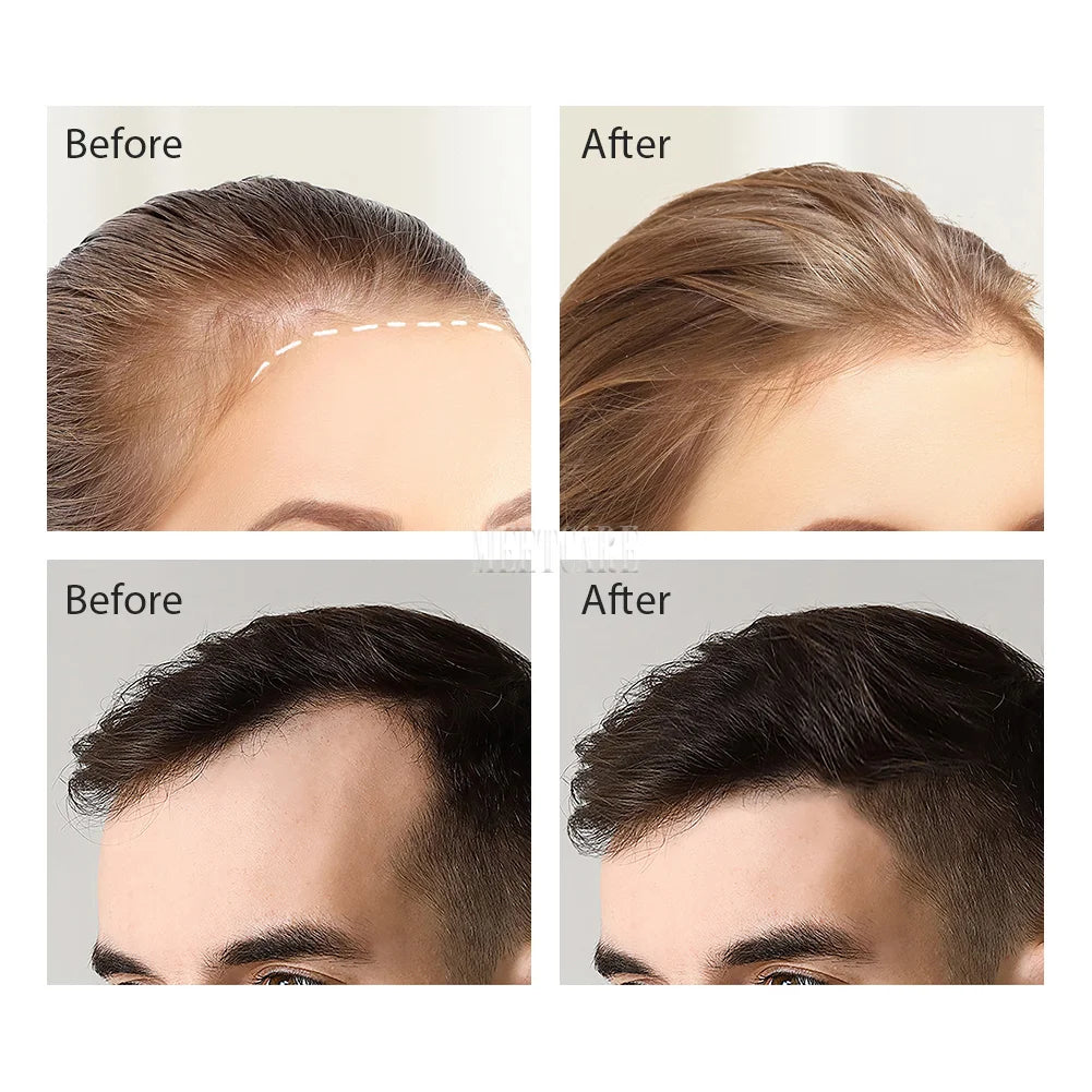Avant et après traitement avec microneedling 120 aiguilles pour la repousse des cheveux